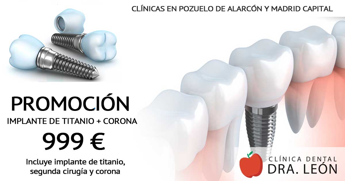 promoción implantes dentales Pozuelo de Alarcón