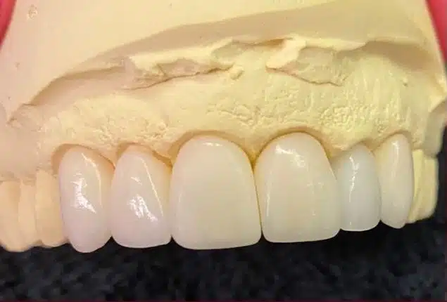 Tipos de carillas dentales